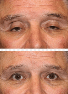ptosis corrective surgery